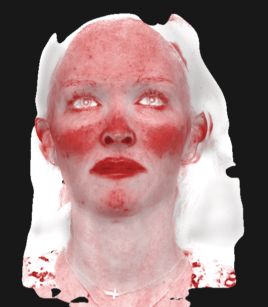 3D Female Model with Red Spots on Face | Medbeautiq in Boca Raton, FL