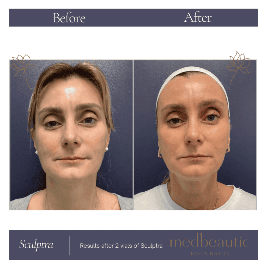 Sculptra Treatment Before & After Photos | Medbeautiq in Boca Raton, FL