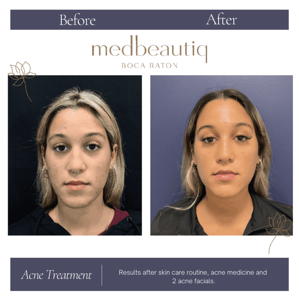Female Acne Treatment Before & After Photos | Medbeautiq in Boca Raton, FL