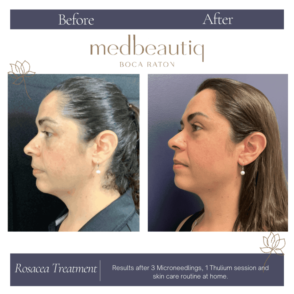 Rosacea Treatment Before & After Photos | Medbeautiq in Boca Raton, FL
