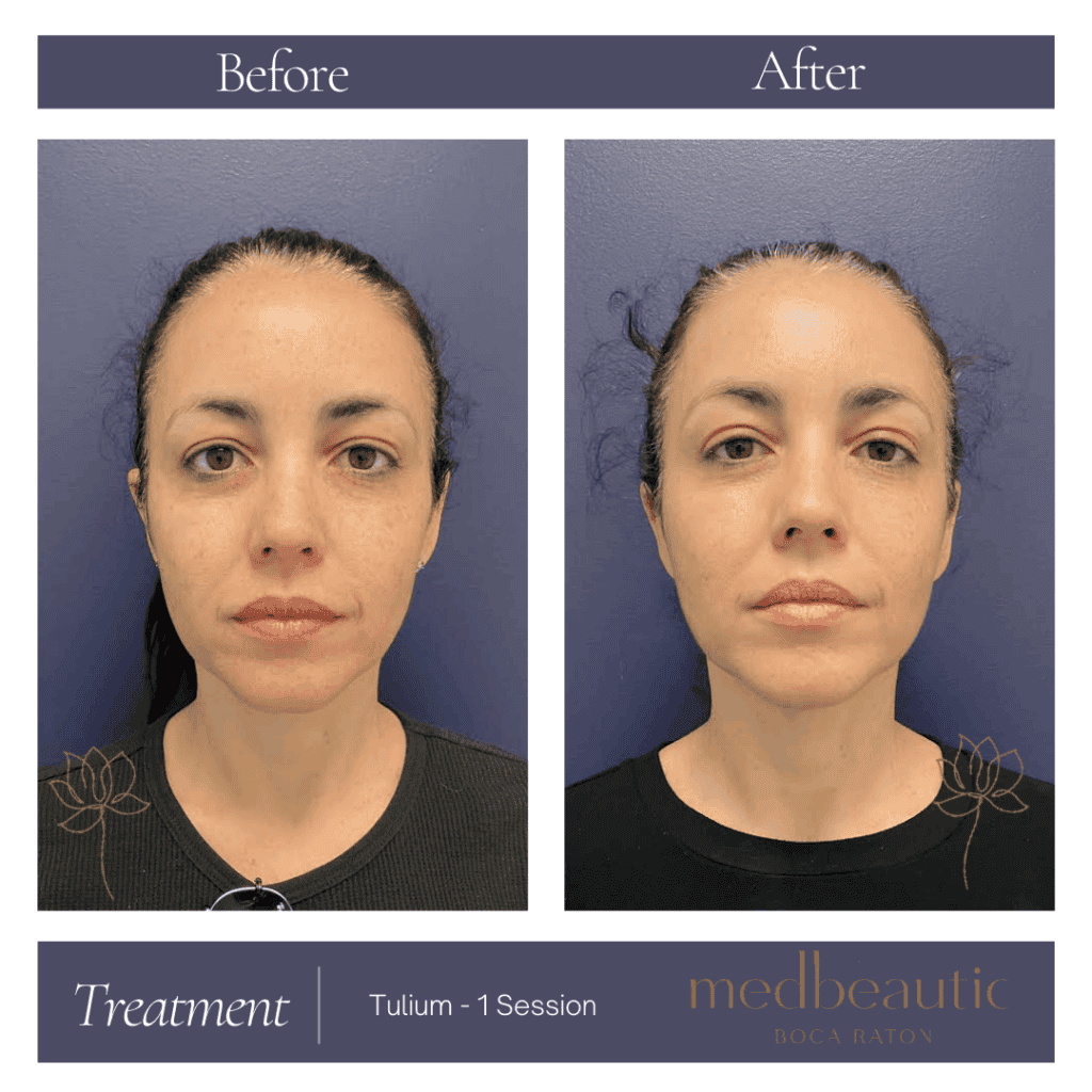 Tulium Treatment Before & After Photos | Medbeautiq in Boca Raton, FL