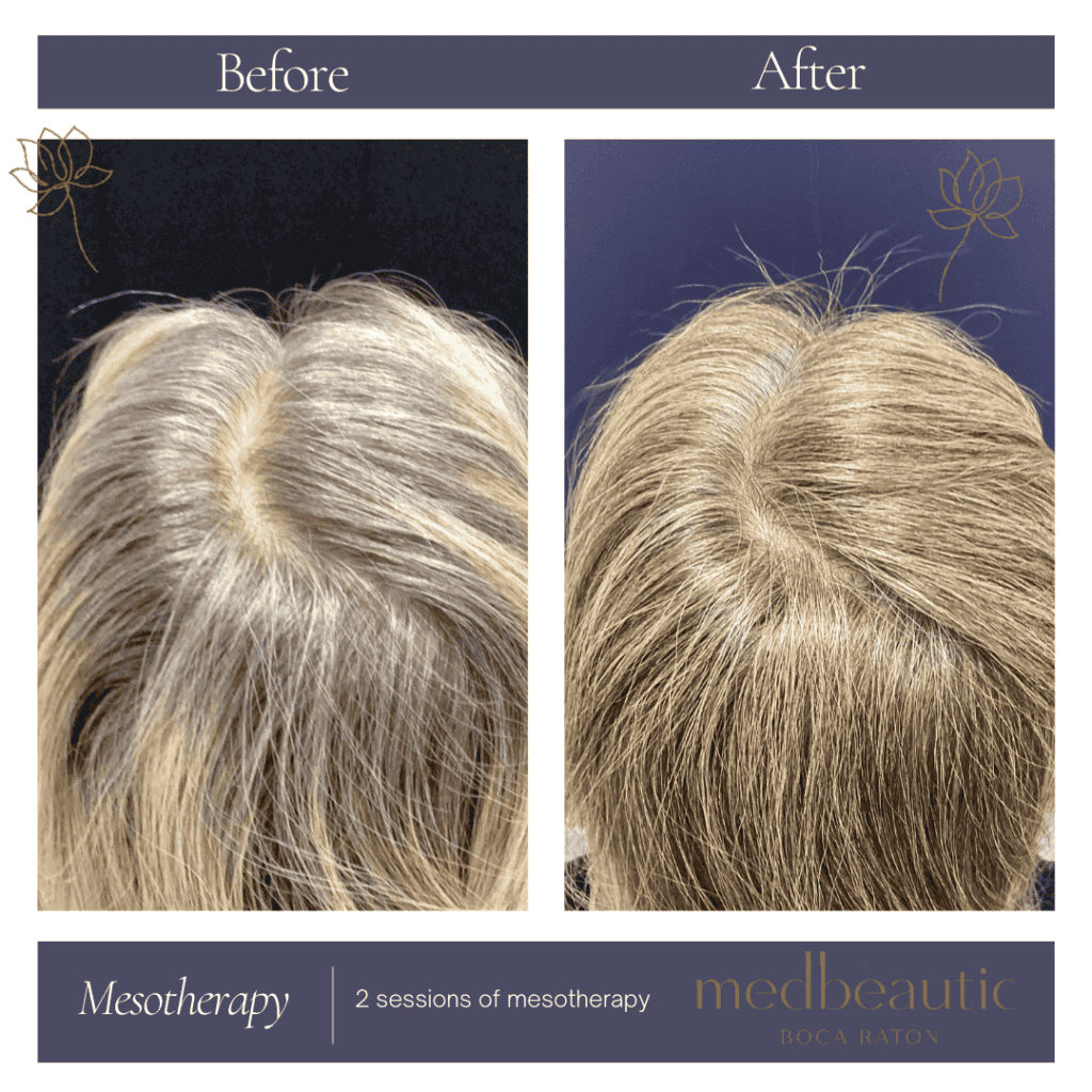 Mesotherapy Before & After Photos | Medbeautiq in Boca Raton, FL