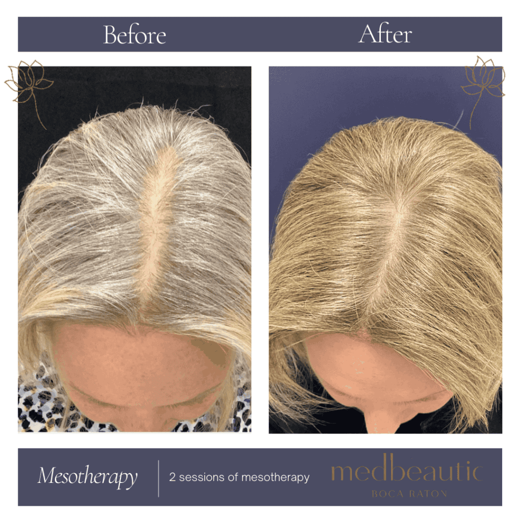 Mesotherapy Before & After Photos | Medbeautiq in Boca Raton, FL