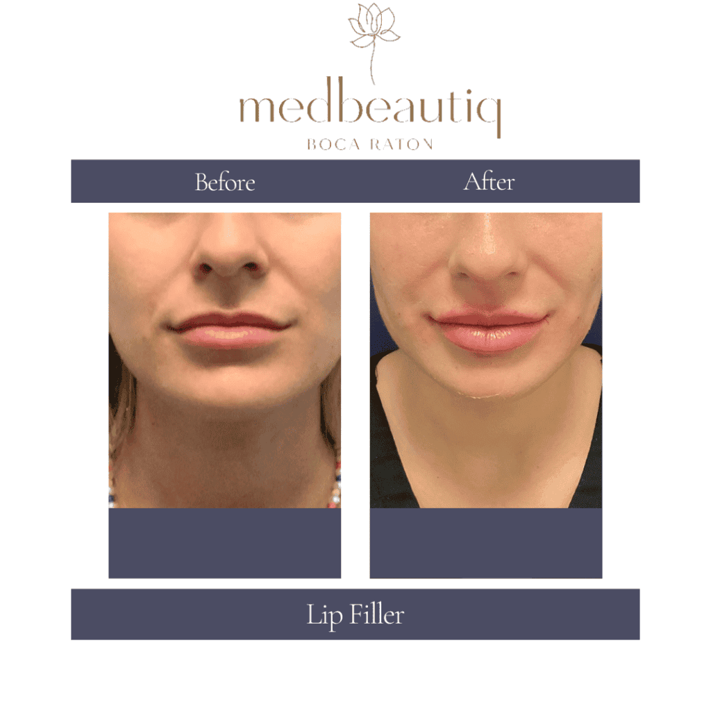 Results of Young Female Face with Dermal Lip Fillers treatment before and after Closeup | Body Contour specialist | Medbeautiq in Boca Raton, FL