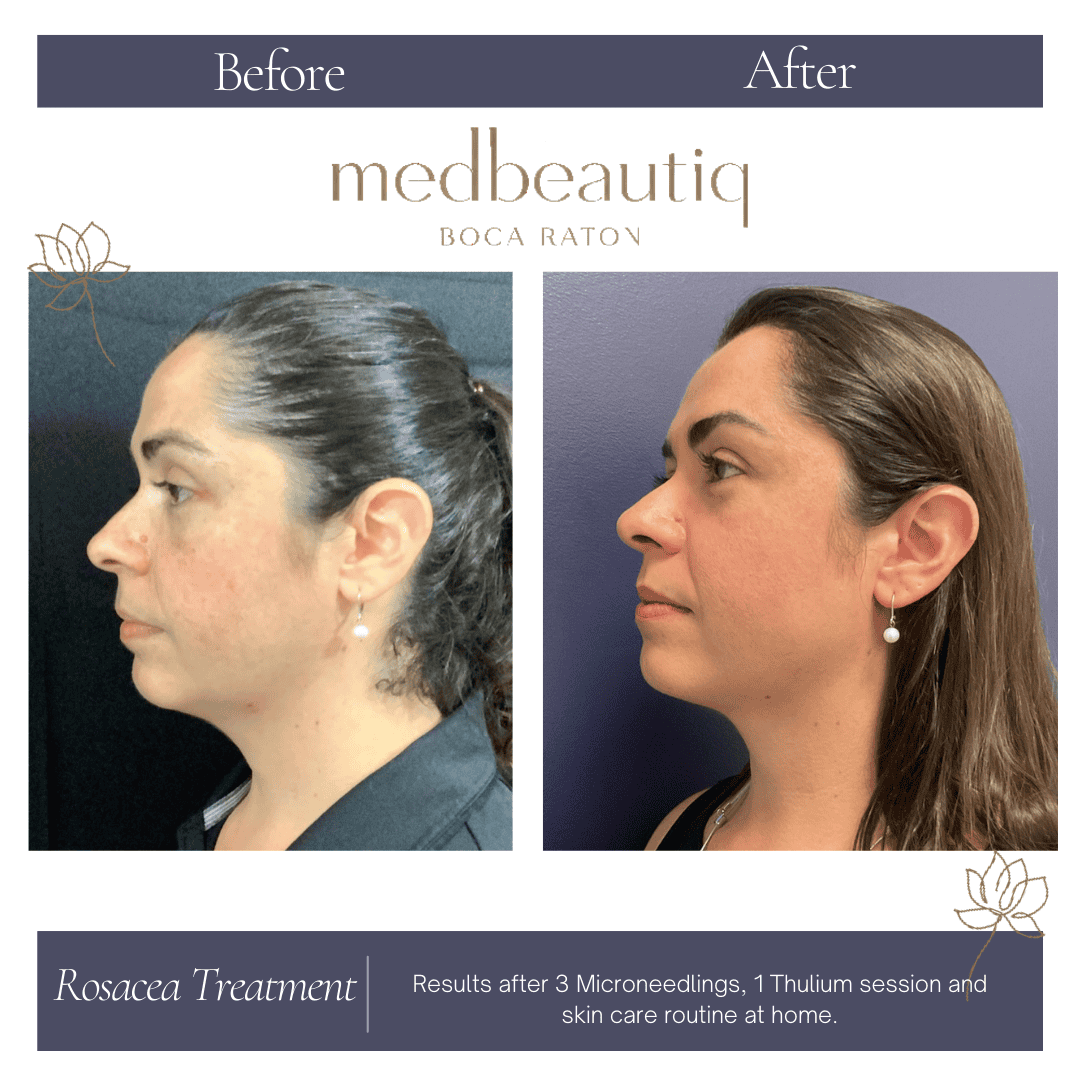 5-year-old woman after MMP microneedling & Thulium laser