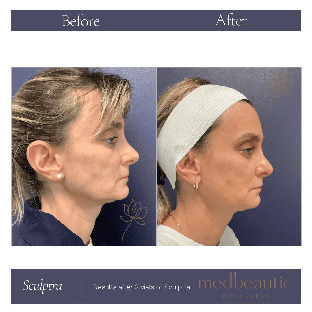 Female age 50 visible improvement from Sculptra body treatment