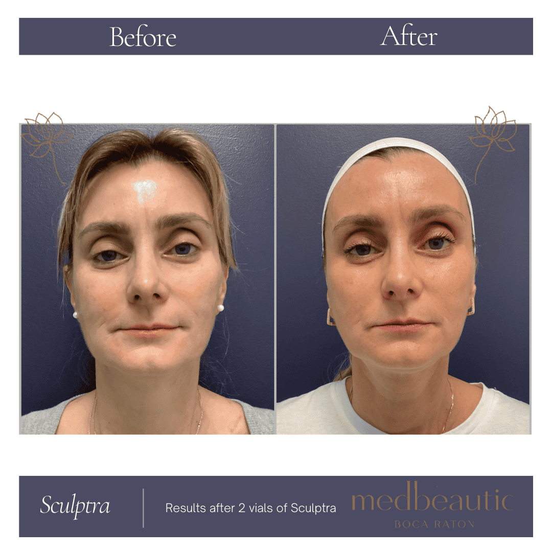 50-year-old woman after Sculptra body volume treatment