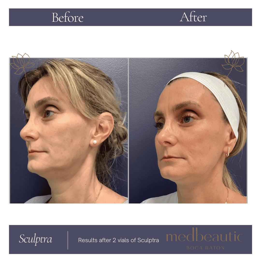50-year-old woman after Sculptra body-contouring treatment