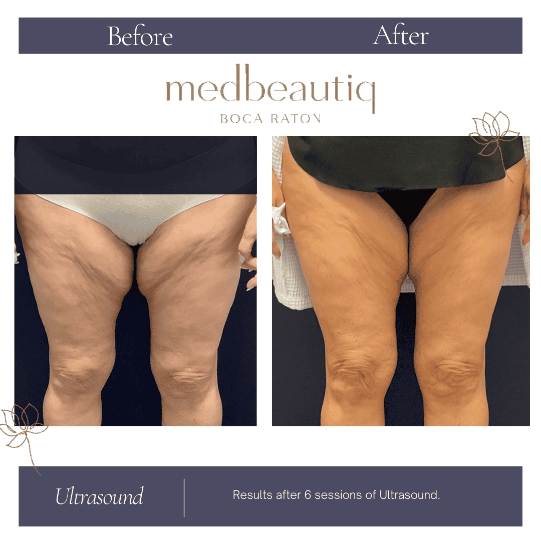 Female 63: ultrasound skin-tightening treatment result