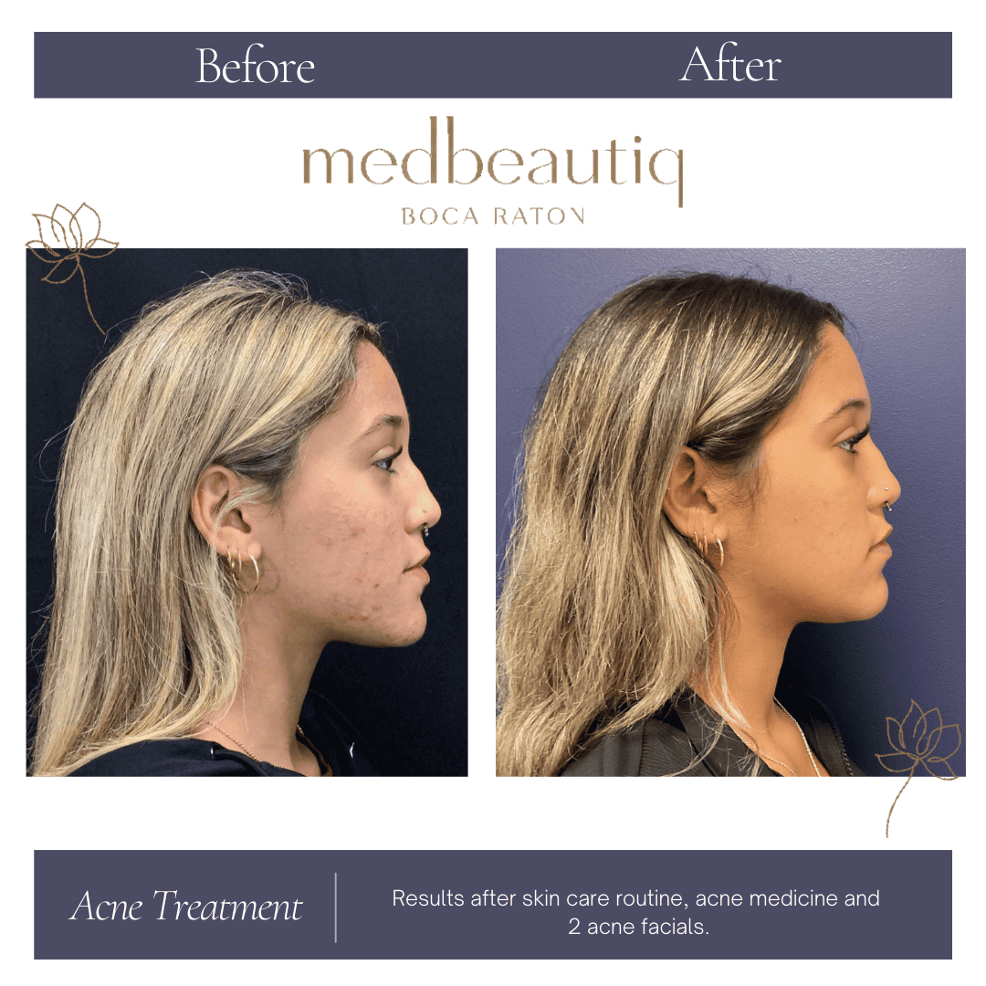 Female 17 acne treatment: before & after result photo