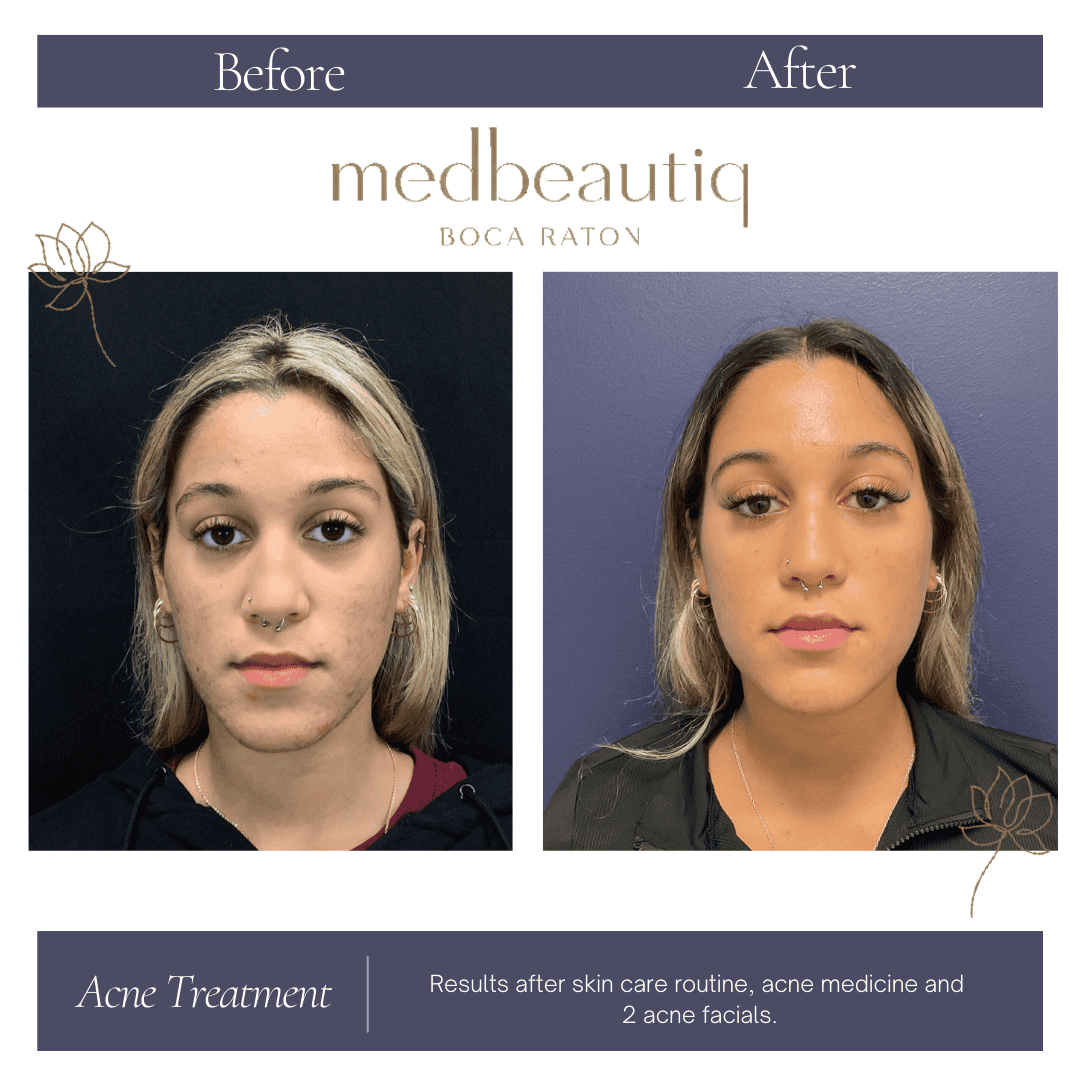 17-year-old female teen after acne treatment improvement