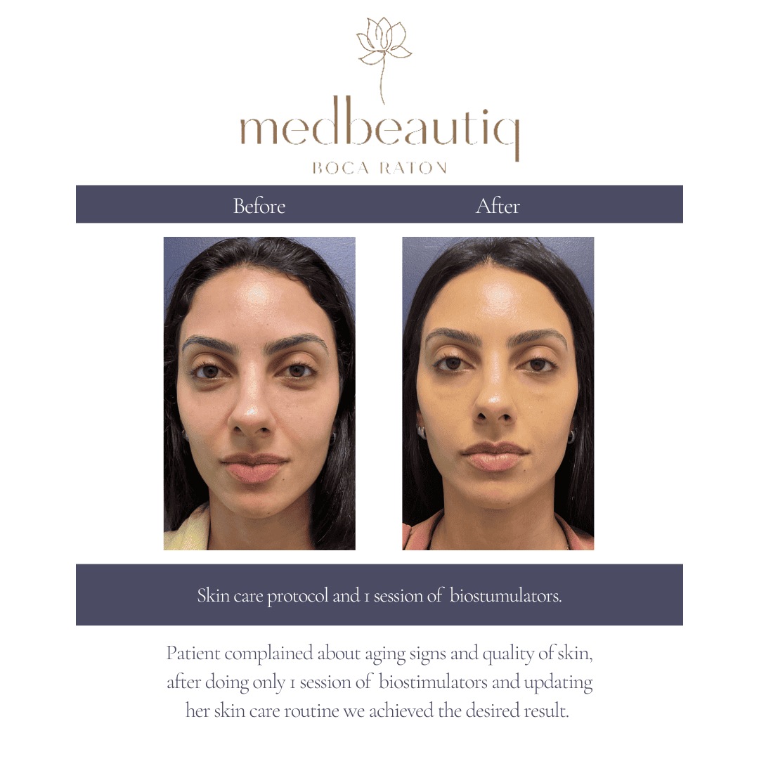 33-year-old woman before & after biostimulators + skincare