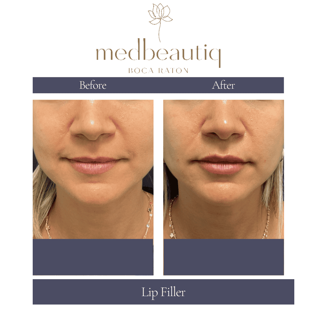 Female age 34 with subtle lip-filler enhancement result