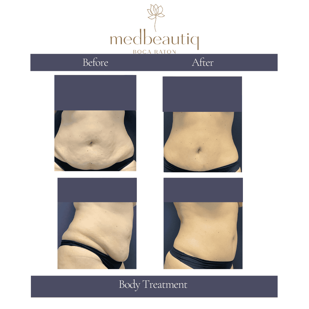 3-year-old woman after body-sculpting treatment outcome