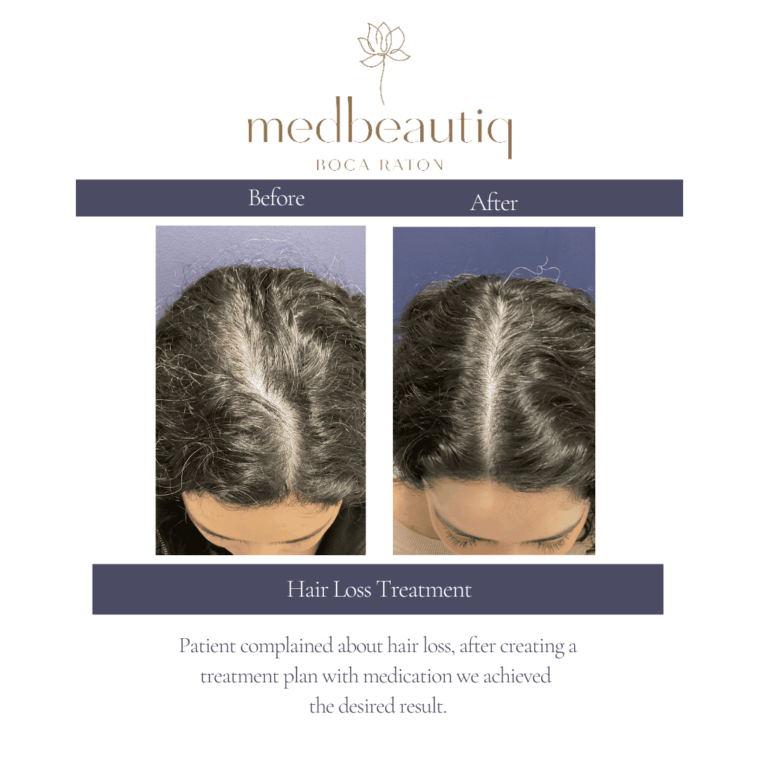 Female age 44 receiving hair-loss therapy at aesthetic clinic