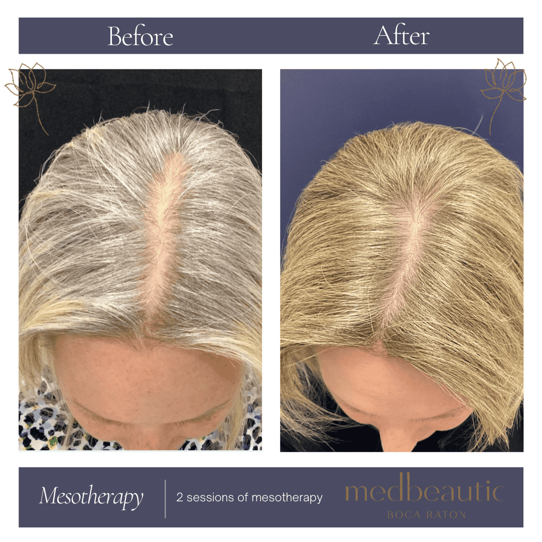 7-year-old woman hair-loss mesotherapy before & after