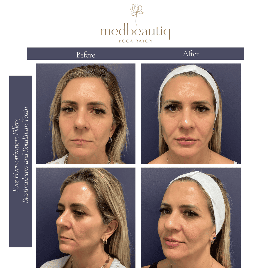 Female 48: face harmonisation non-surgical aesthetic result