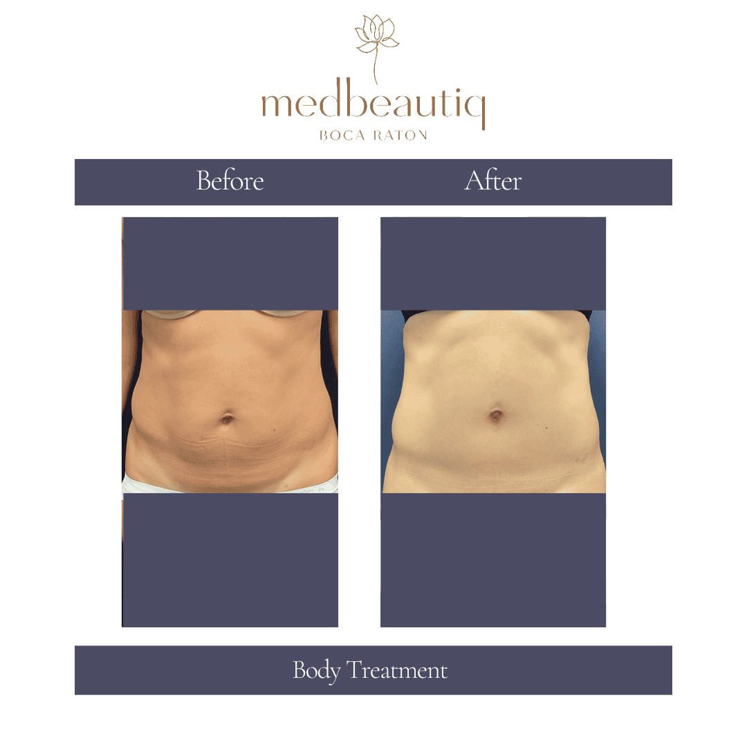 50-year-old woman after body sculpting treatment outcome