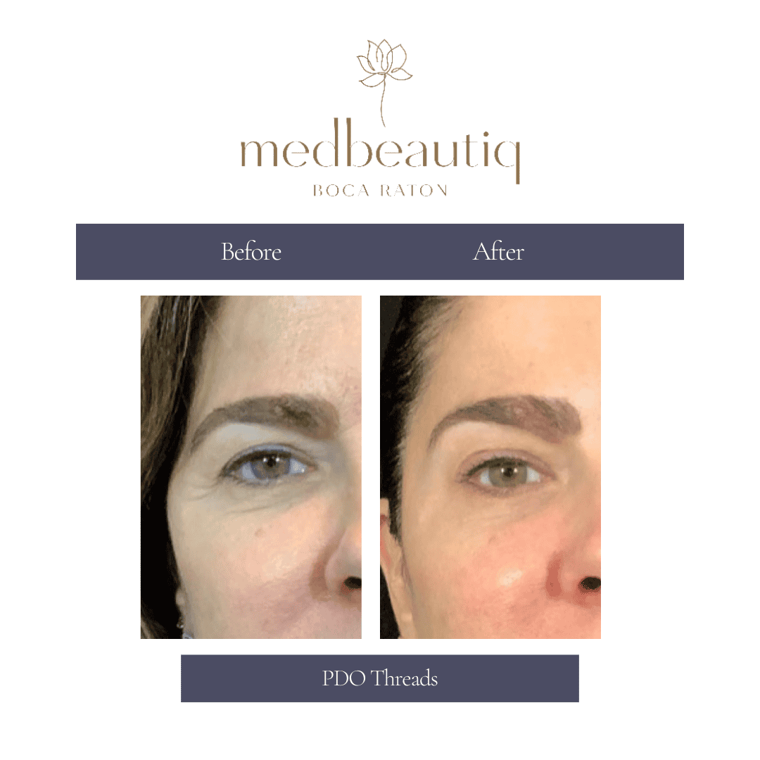 Female 52: PDO thread lift facial result before & after