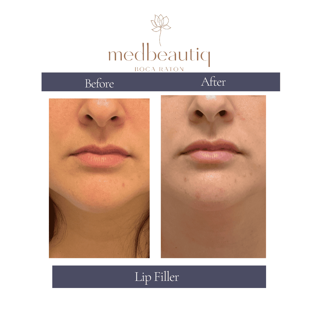 before & after lip filler enhancement at Medbeautiq