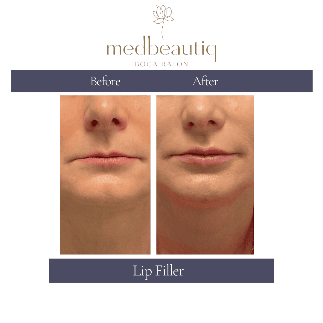 Patient Leticia’s lips after lip-filler treatment