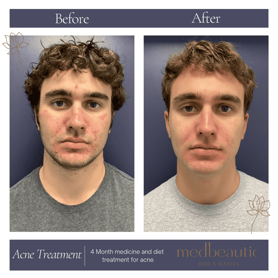 17-year-old male acne-treatment outcome clear skin