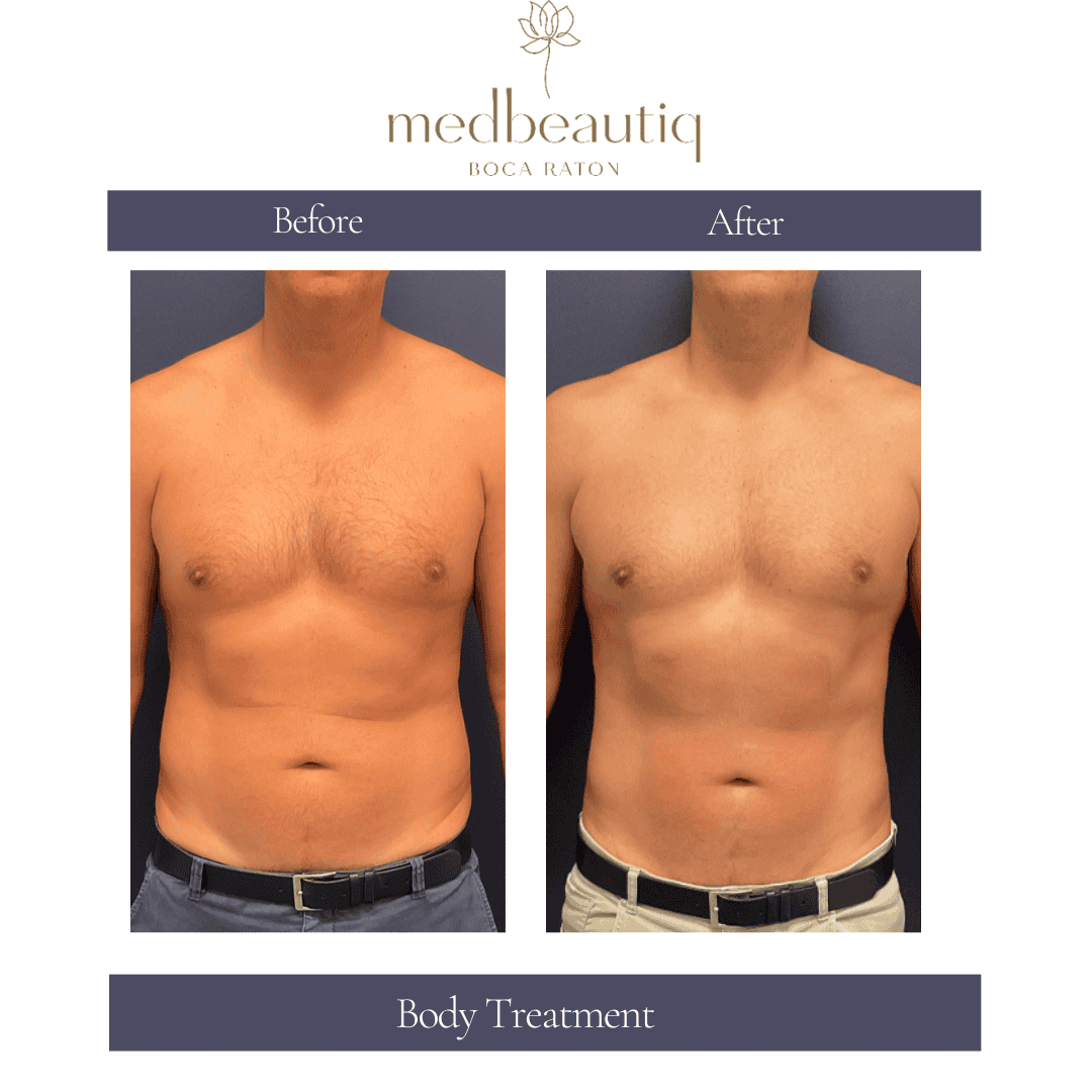 Male 51: body-treatment result front view before & after