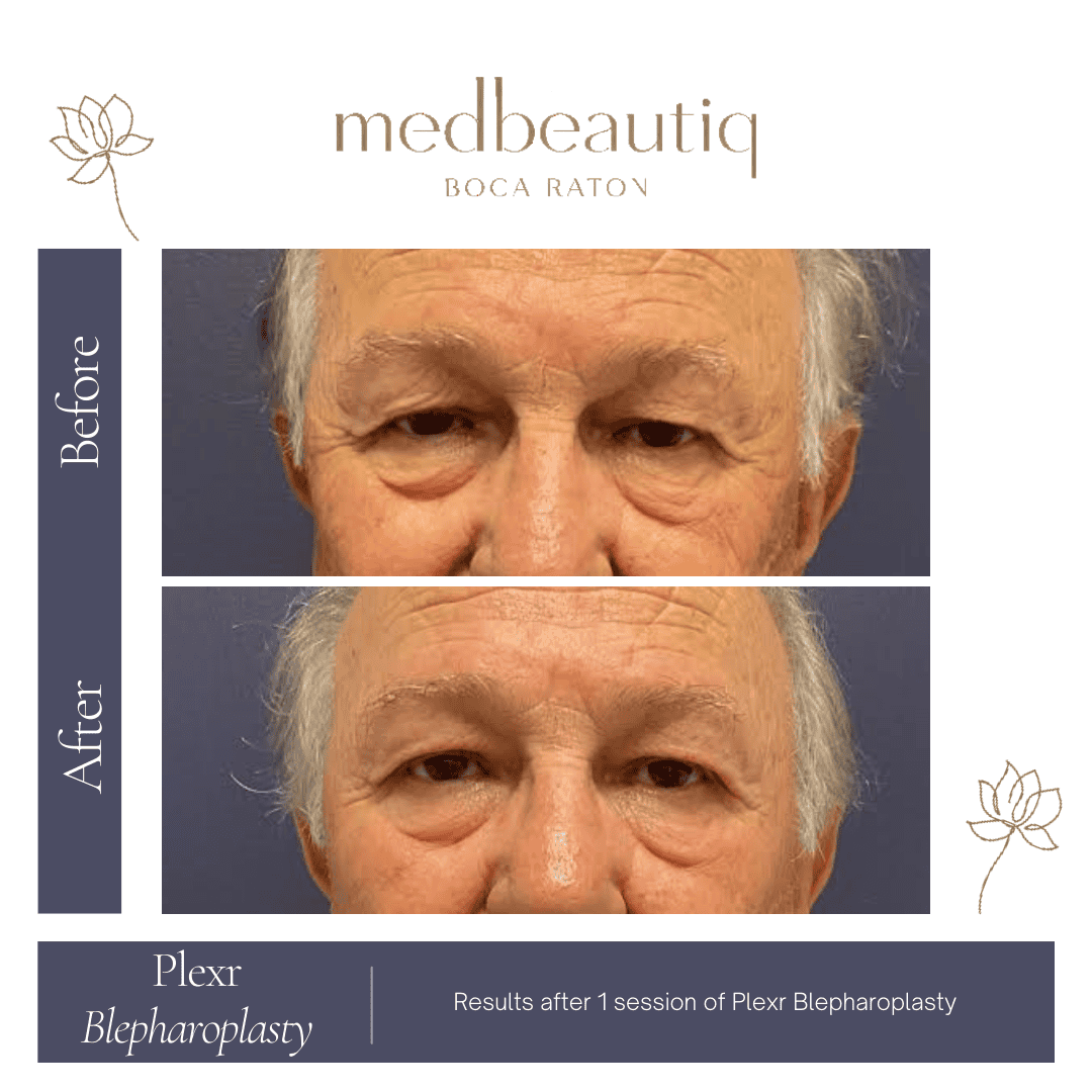 Male patient blepharoplasty result using Plexr non-surgical