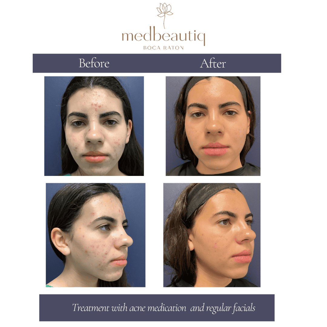 Teen acne treatment – before and after skin improvement