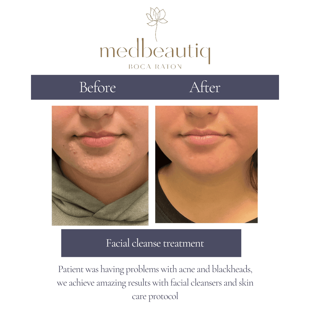 Facial cleanse treatment result – before and after skin