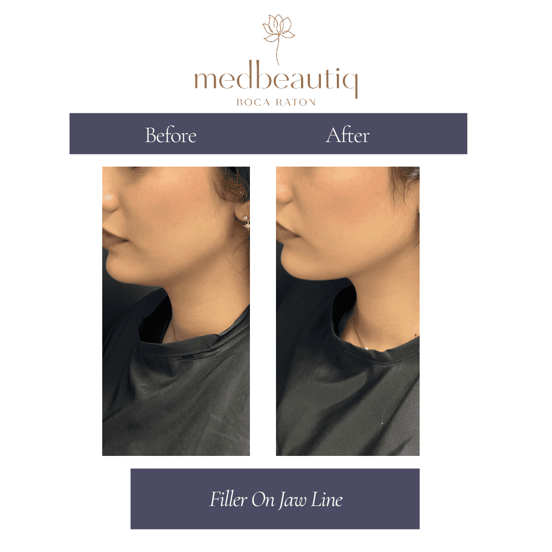 Before & after jaw-line contouring result on patient