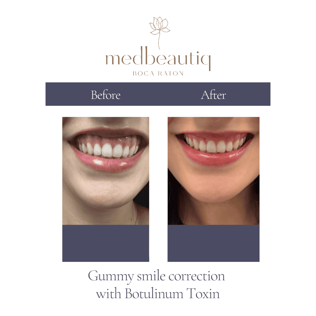 Before and after male gummy smile correction result