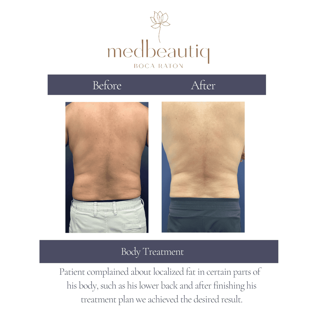 Male patient Richie showing back improvement – before & after