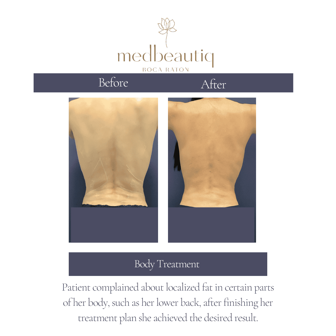 Female patient back transformation: before and after outcom