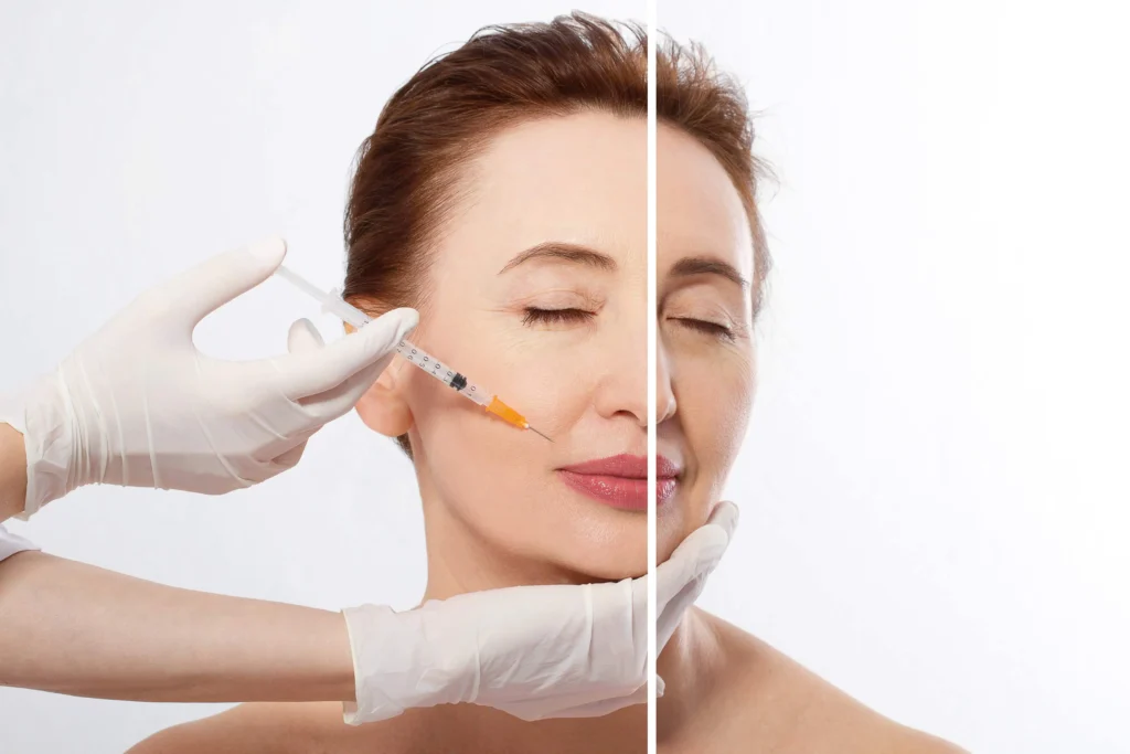 Dermal Fillers