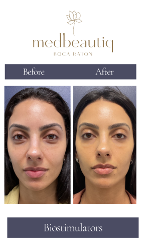 Female,33, biostimulators and skin care - story (2)