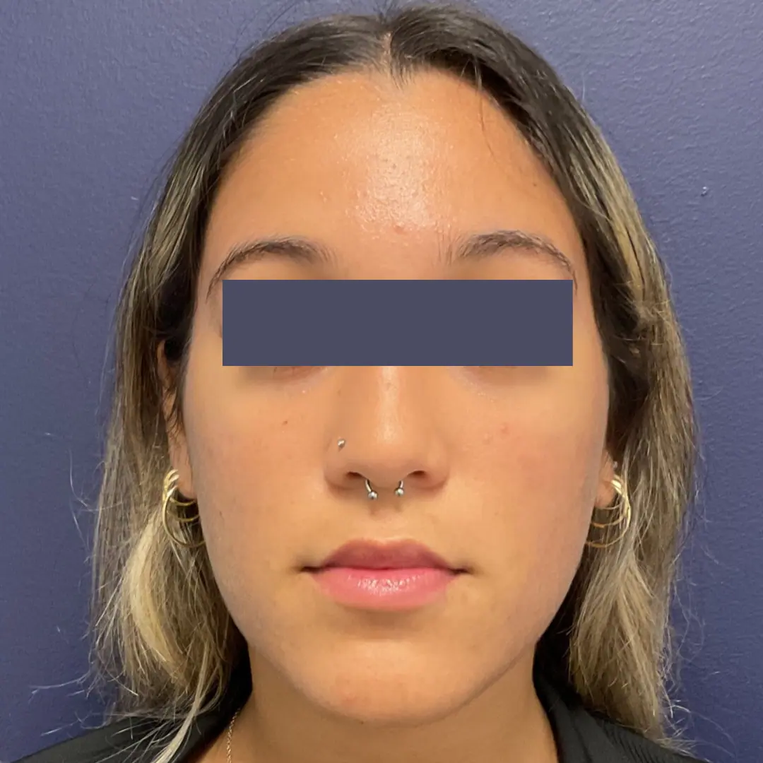 Before and after gallery